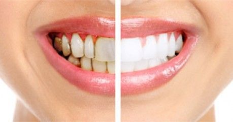 yellow and white teeth comparison 