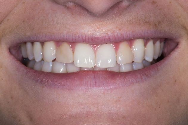before cosmetic dentistry